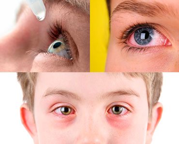 Conjuntivitis ¿Qué Es? Causas, Signos, Síntomas Y Conjuntivitis ¿Qué Es? Causas, Signos, Síntomas Y