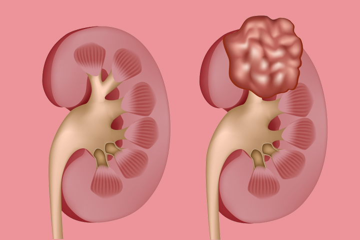 Dolor De Riñones (De Costado): Causas, Tratamiento Y Dolor De Riñones (De Costado): Causas, Tratamiento Y