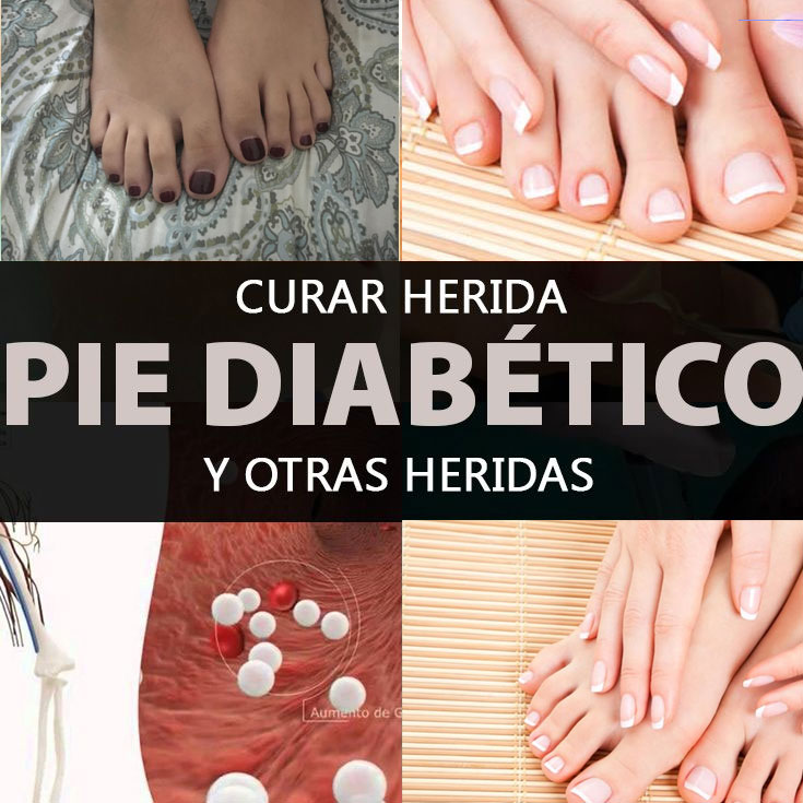 Curar Herida Pie Diabético Y Otras Heridas La Guía de las Vitaminas
